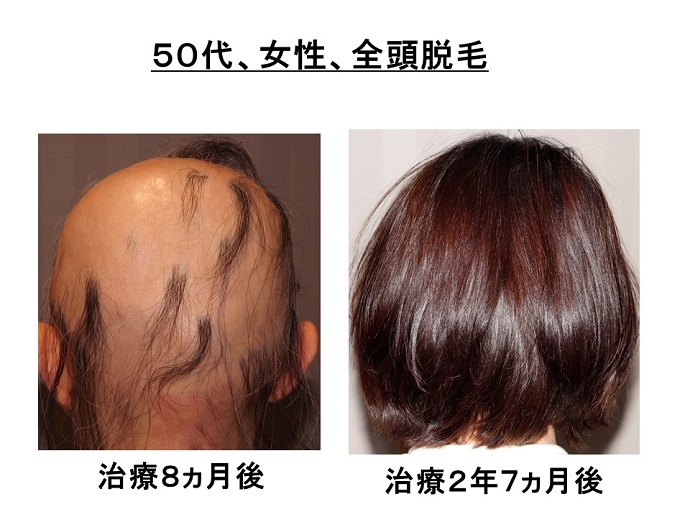 円形脱毛症　病院